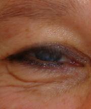 Vrouw, 42 jaar voor ooglidcorrectie