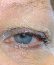 Vrouw, 49 jaar voor de ooglidcorrectie
