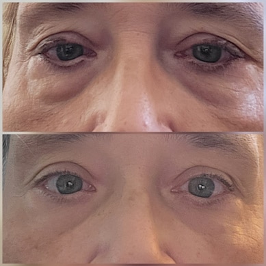 4 maanden na laserlift-onderooglidcorrectie