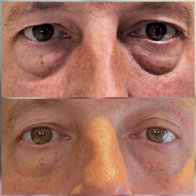 4 maanden na laserlift-onderooglidcorrectie