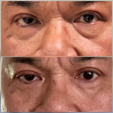 4 maanden na laserlift-onderooglidcorrectie